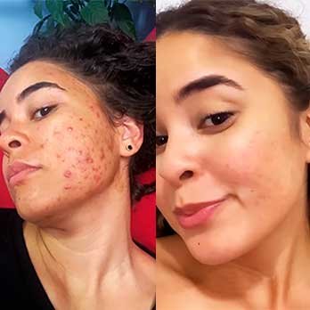 Antes e depois do tratamento com RenovaDerme