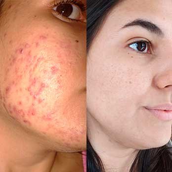 Antes e depois do tratamento com RenovaDerme