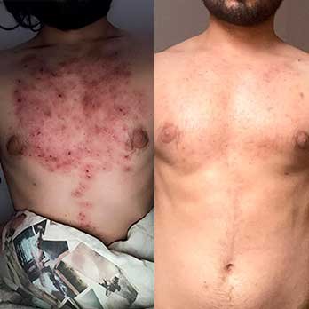 Antes e depois do tratamento com RenovaDerme