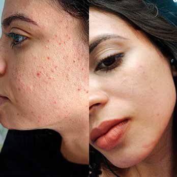 Antes e depois do tratamento com RenovaDerme